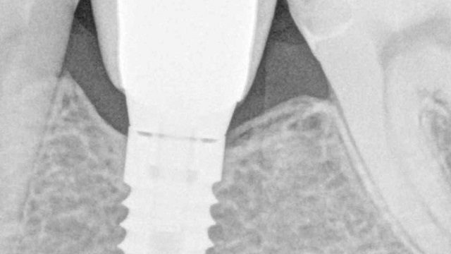 Cinical: Is zero bone loss a possibility when placing implants?